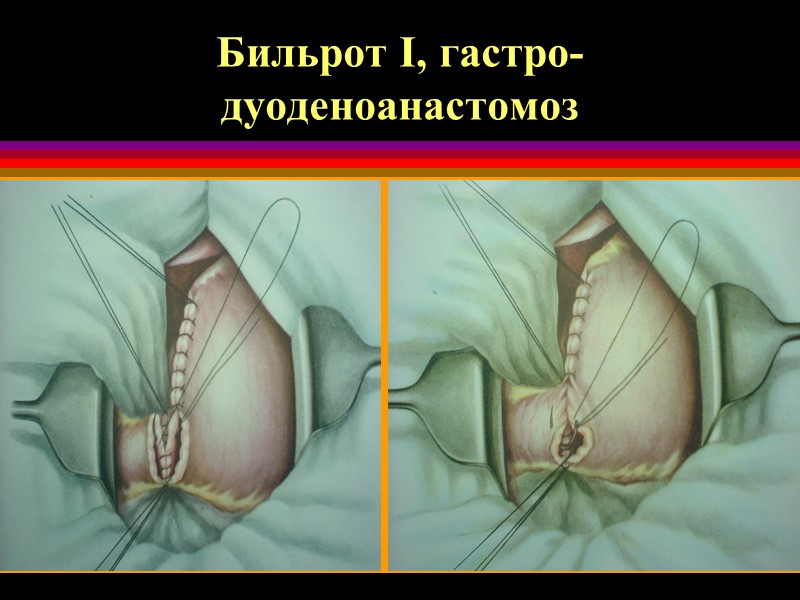 Бильрот I, гастро-дуоденоанастомоз